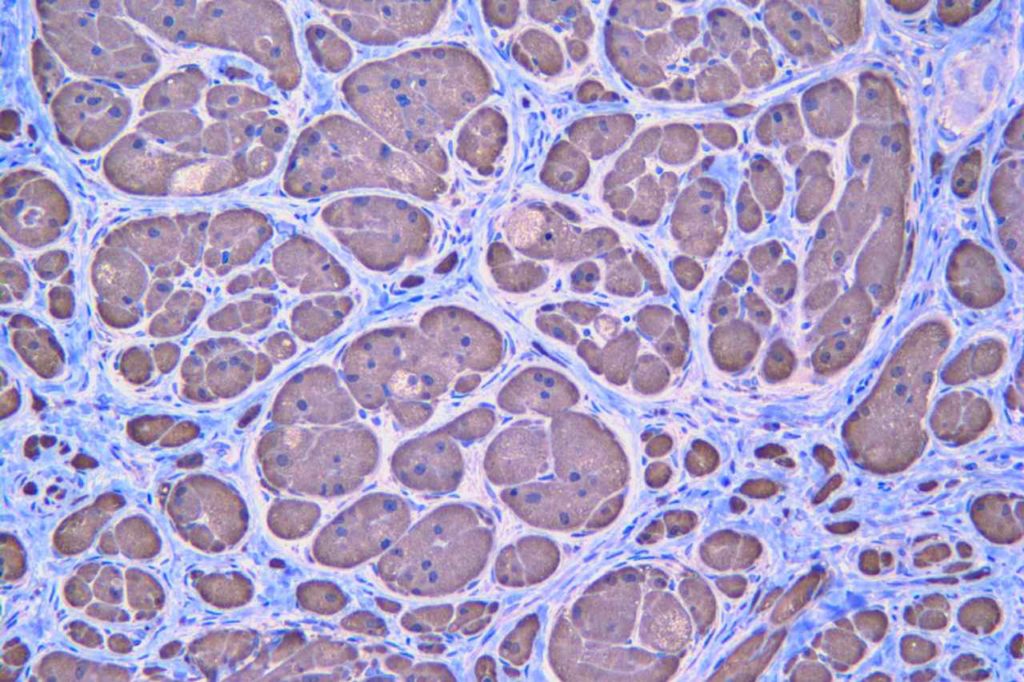 S-100 - Granular Cell Tumor
