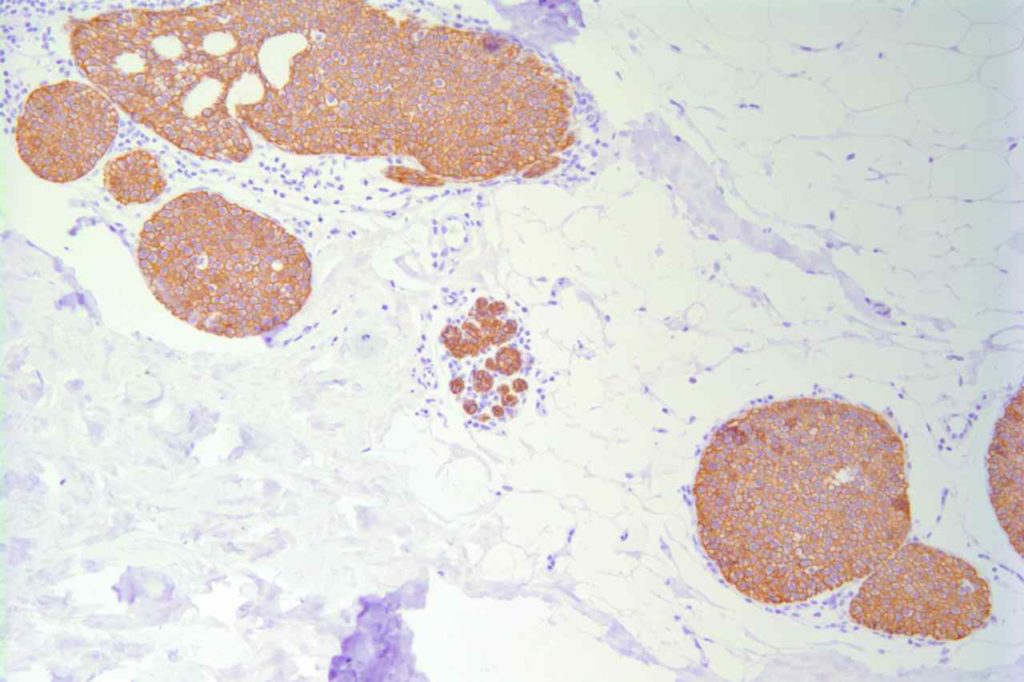 E-Cadherin - Breast DCIS