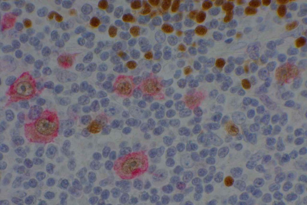 CD30-PAX5 double stain in classical Hodgkin lymphoma