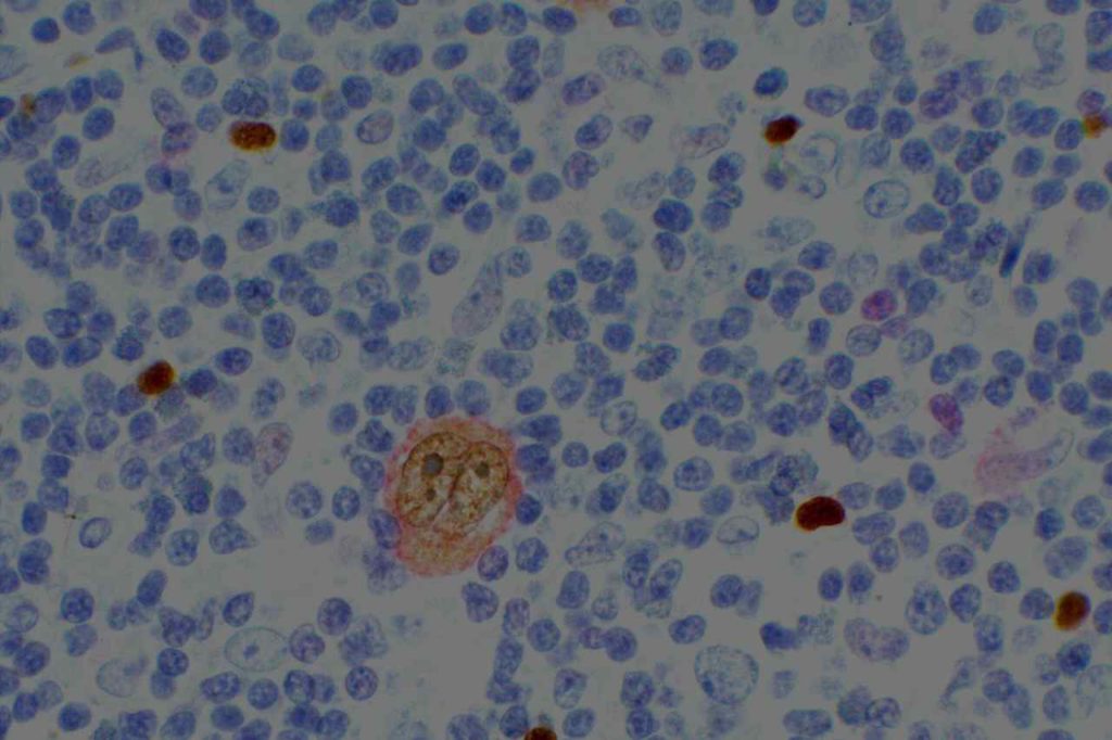 CD30-PAX5 double stain in classical Hodgkin lymphoma