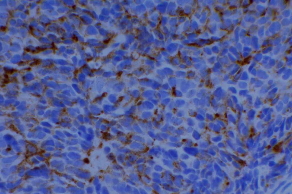 Chromogranin A - Merkel Cell Carcinoma