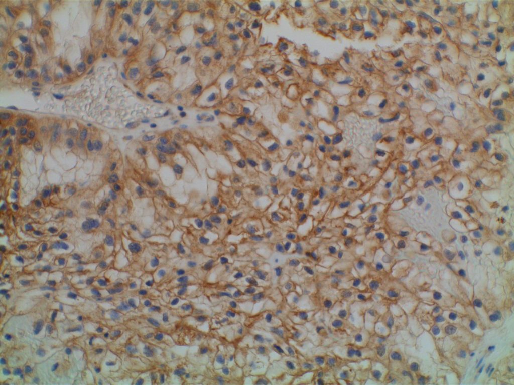 GATA-3 Renal Cell Carcinoma