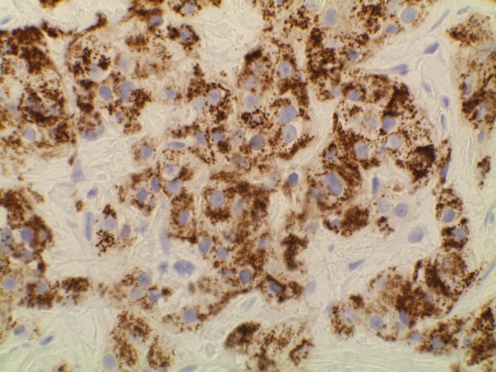 Her-2 cytoplasmic staining