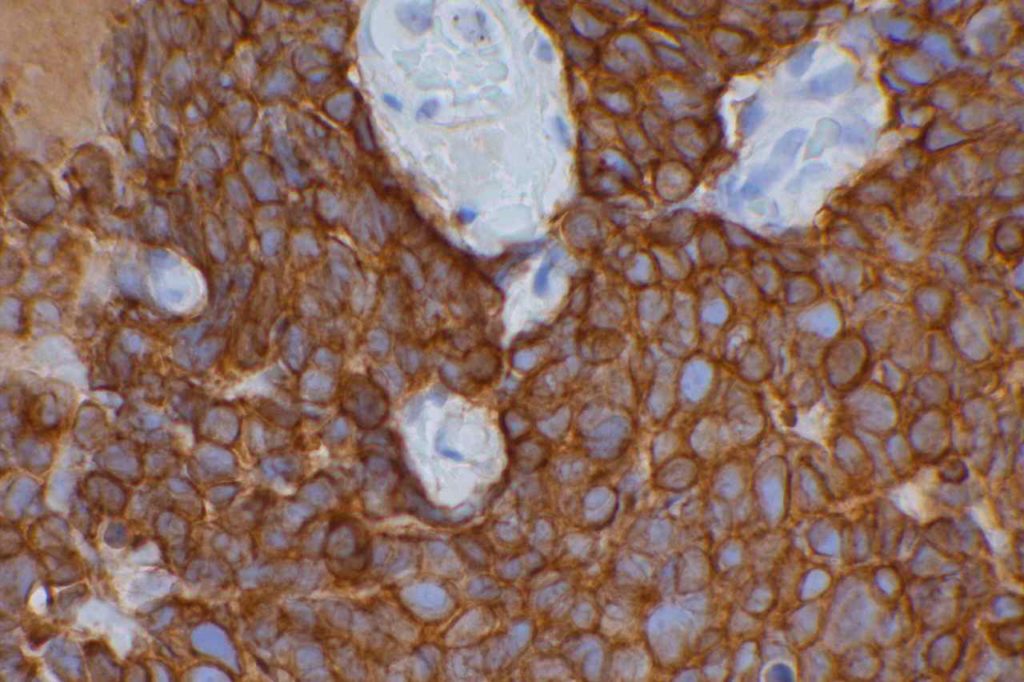 CAM5.2 - Lung Small Cell Carcinoma
