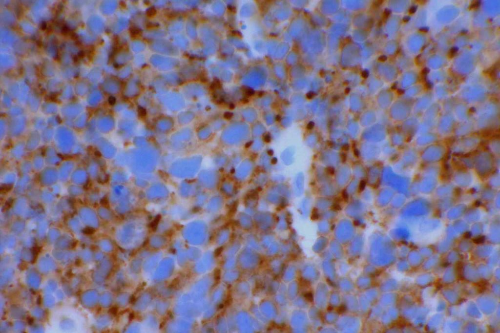 Synaptophysin - Merkel Cell Carcinoma