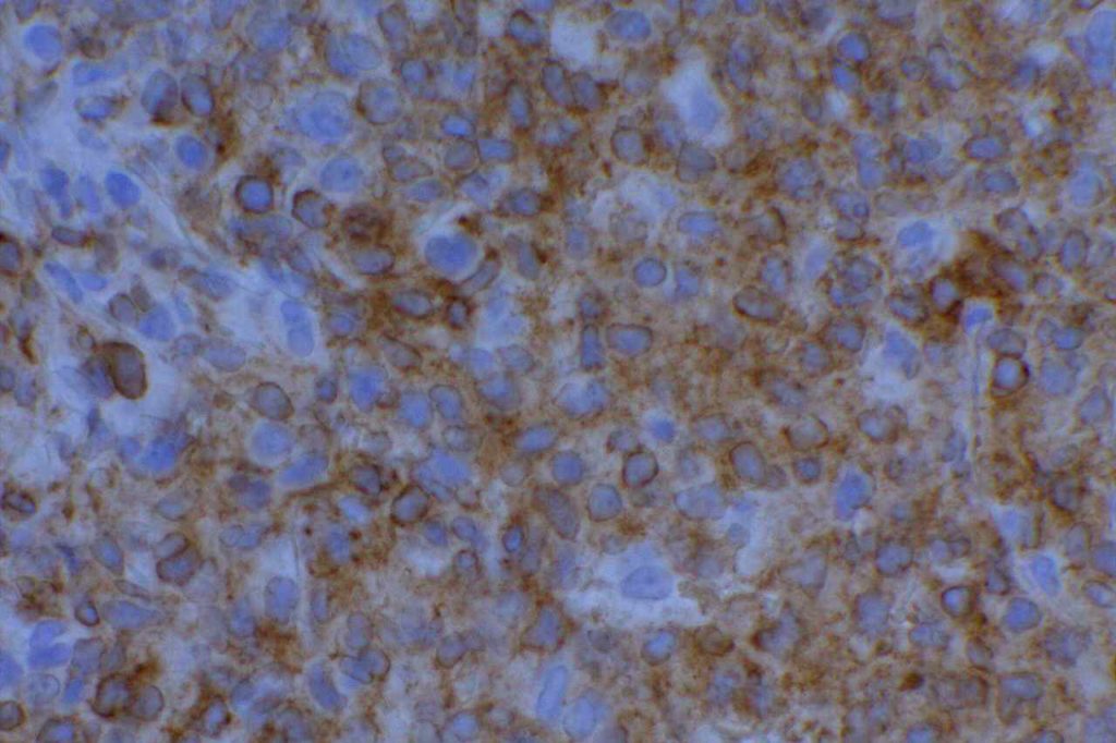 CD79a - B-cell lymphoma