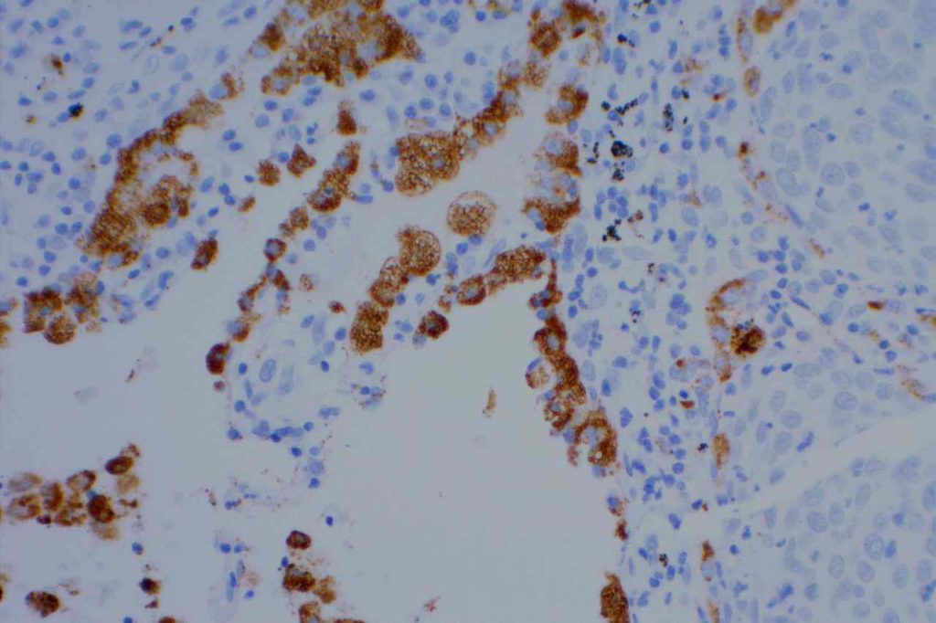 Napsin A - Lung Squamous Cell Carcinoma