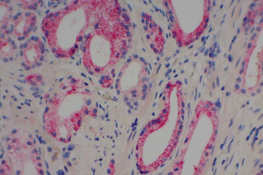PIN-4 Prostate Adenocarcinoma