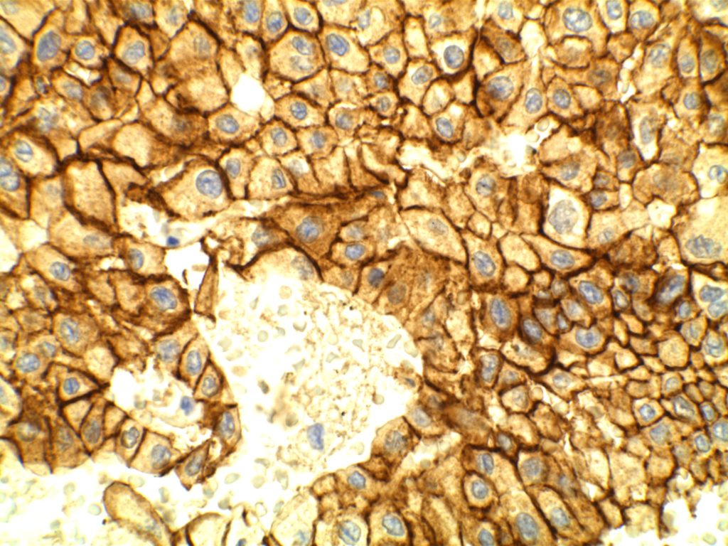 Chomophobe Renal Cell Carcinoma - E-Cadherin