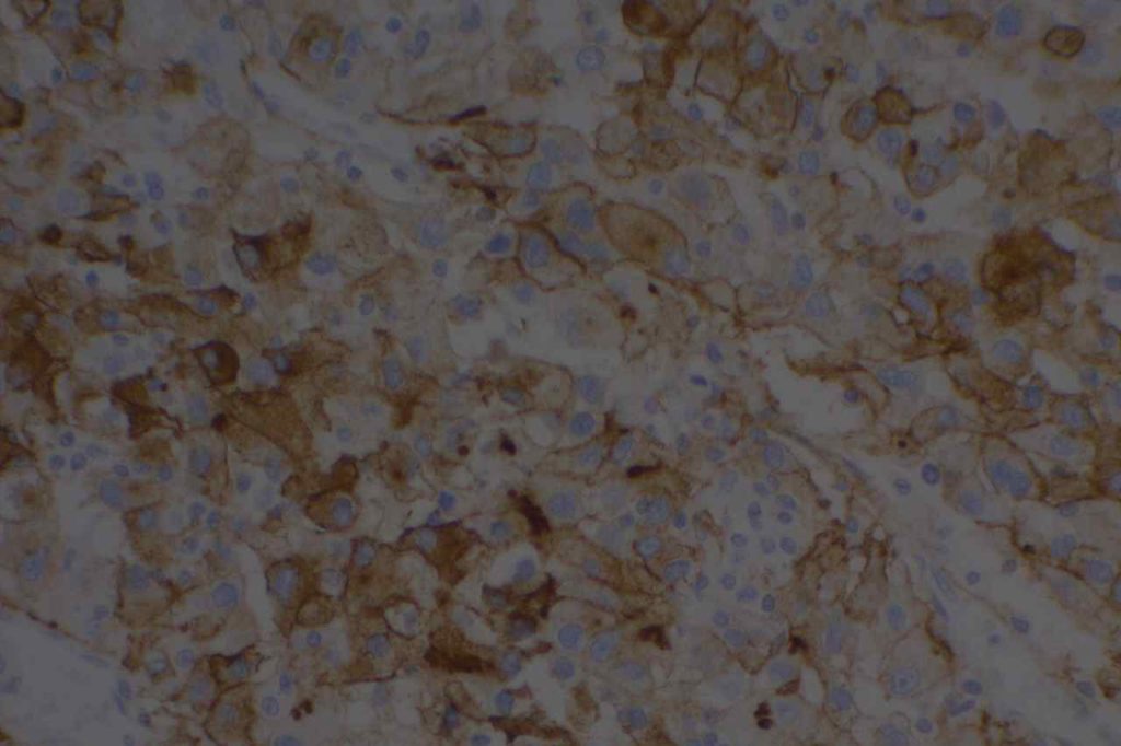 EMA - Renal Cell Carcinoma