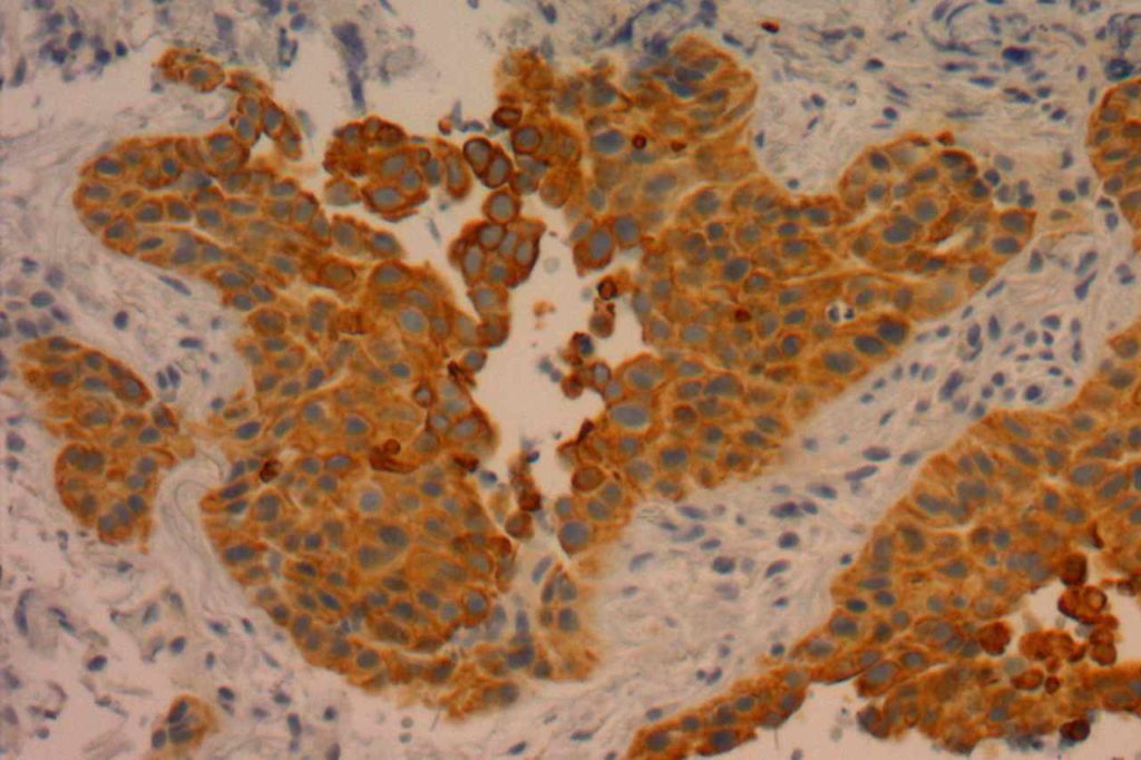 CK5/6 - Lung Squamous Cell Carcinoma