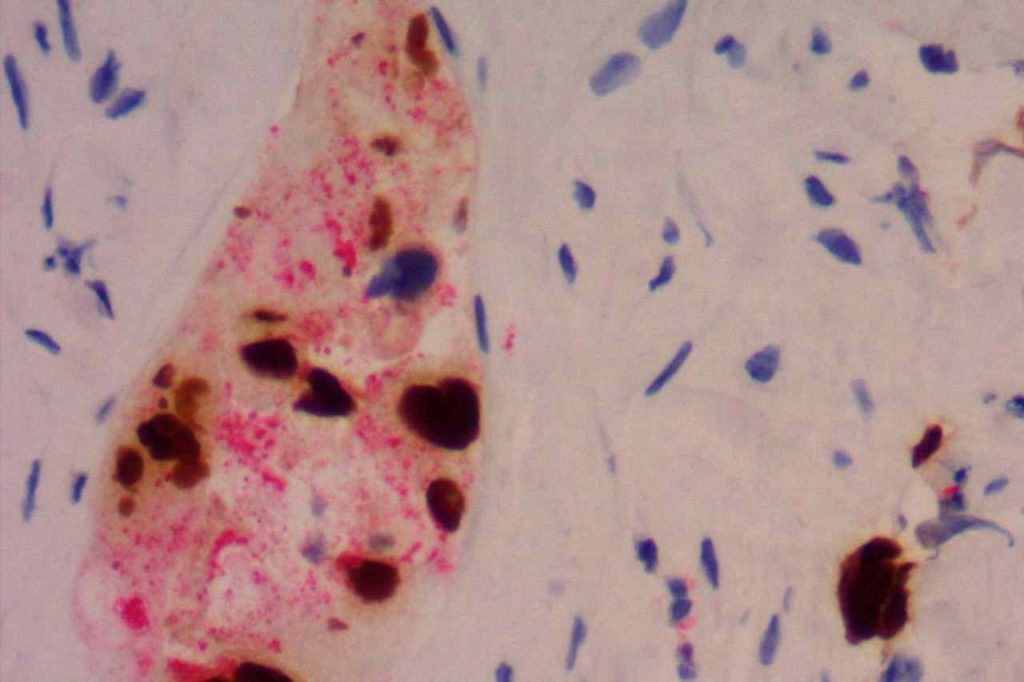 TTF-1/Napsin A (double stain) - Lung Adenocarcinoma