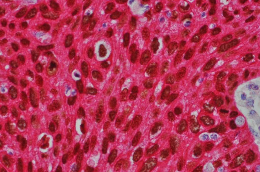 p63-CK5 (double stain) lung squamous cell carcinoma