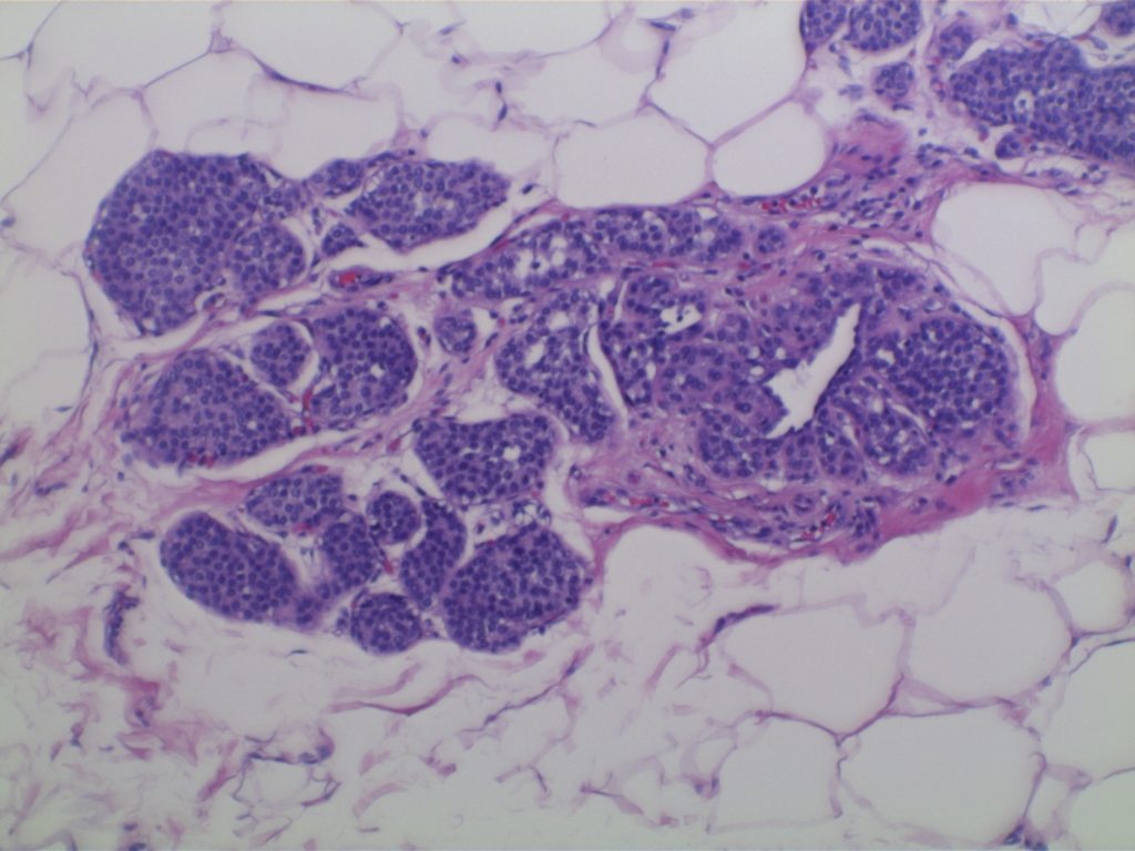 Breast - Lobular Carcinoma In Situ (LCIS)
