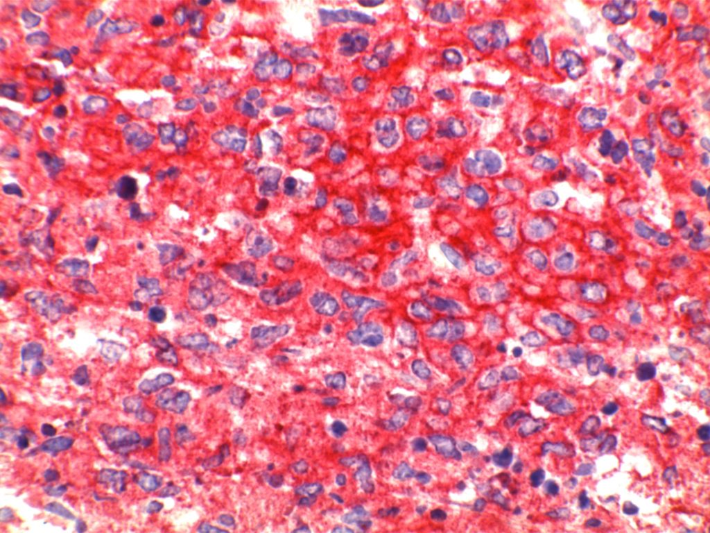 CD30+ Diffuse Large B-Cell Lymphoma