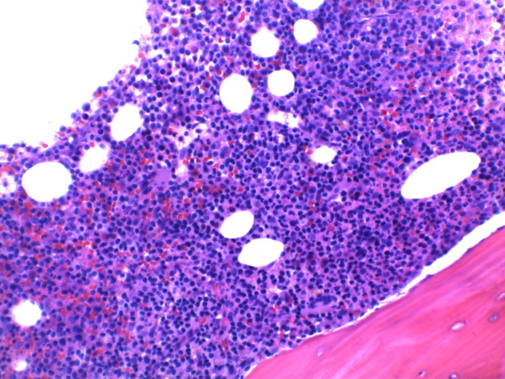Lymphoplasmacytic Lymphoma (LPL) - BM Core Biopsy