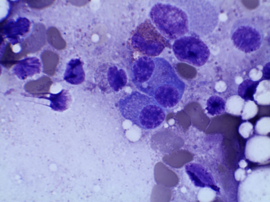 Multiple Myeloma - Plasma Cells Bone Marrow Aspirate