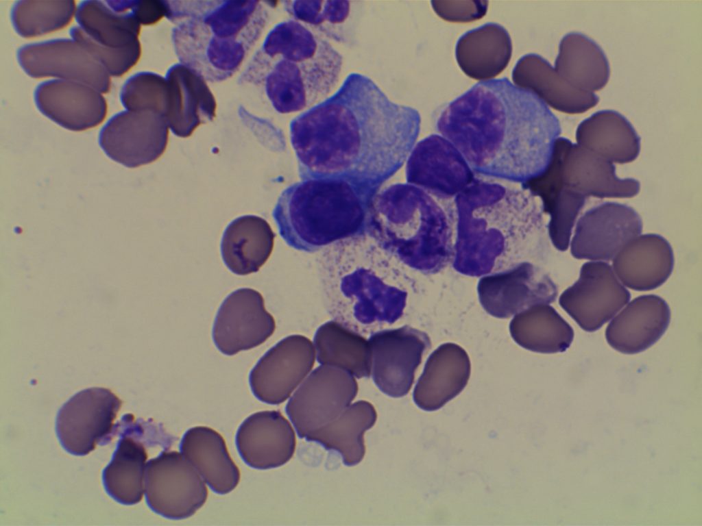 Multiple Myeloma - Plasma Cells Bone Marrow Aspirate