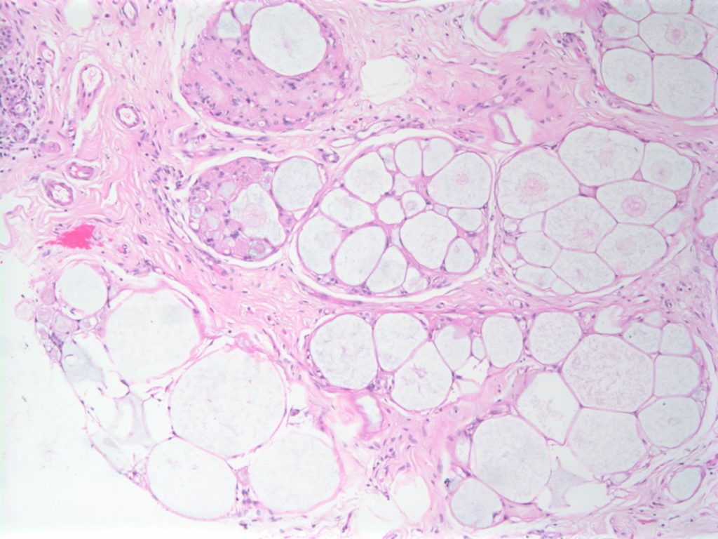 Breast - Collagenous Spherulosis