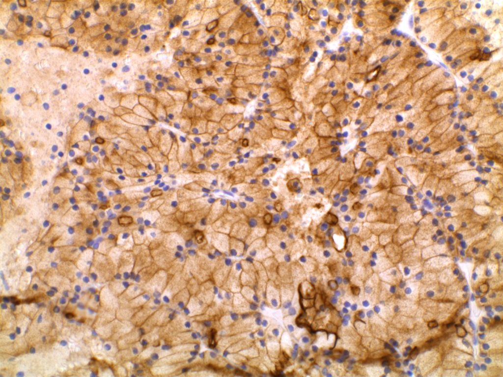 DOG-1 - Acinic Cell Carcinoma (Parotid)