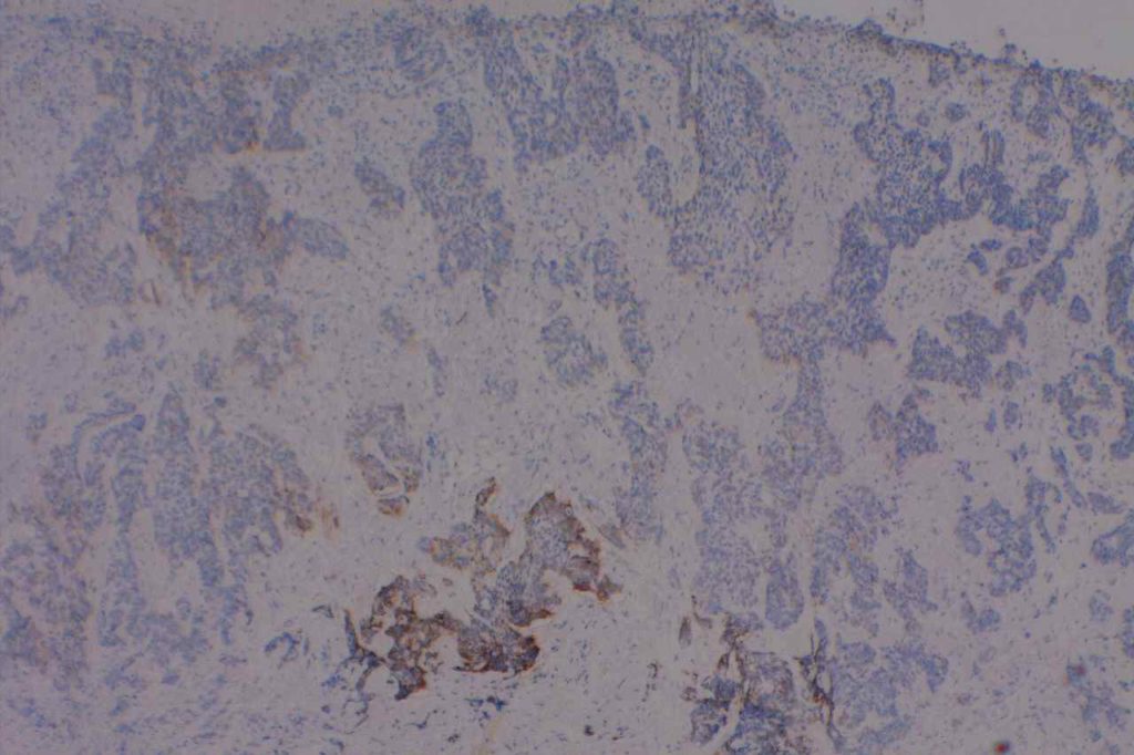 CD56 - Basal Cell Carcinoma