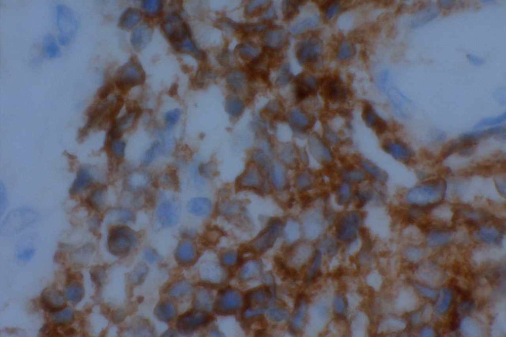 CD56 - Merkel Cell Carcinoma