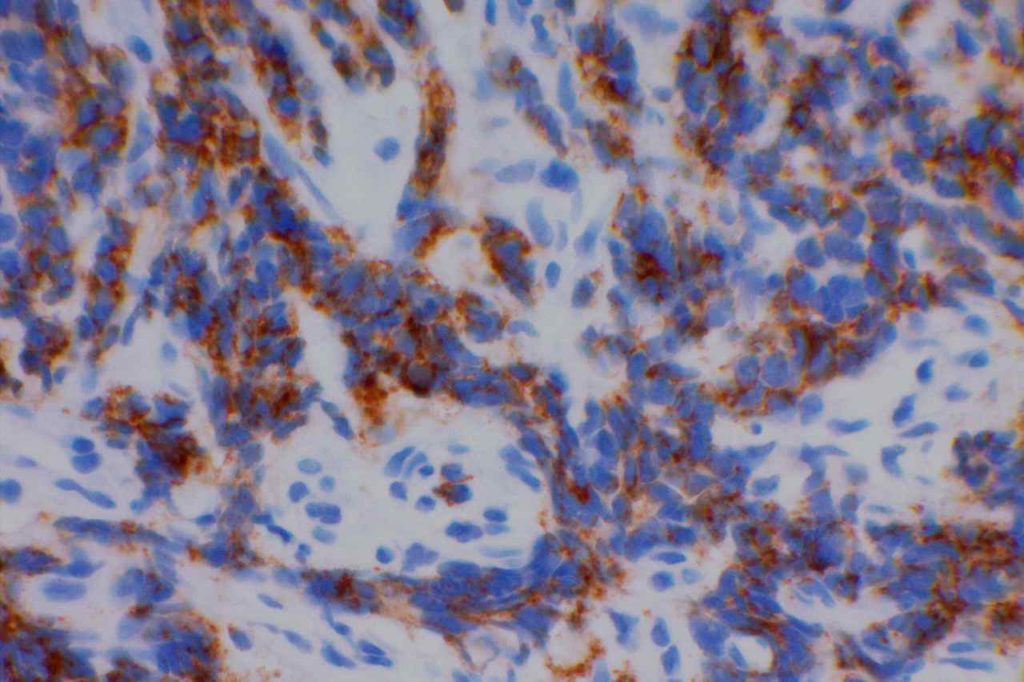 CD56 - Small Cell Carcinoma