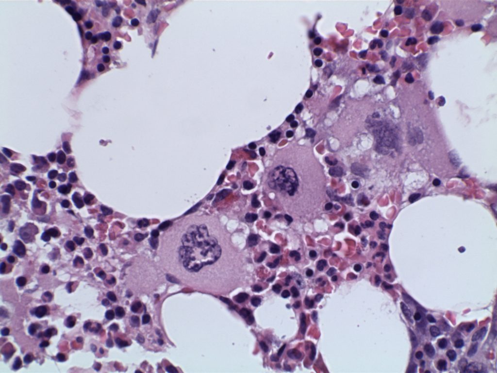 Essential Thrombocytosis (ET)