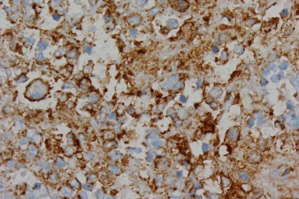 CD1a - Langerhans Cell Histiocytosis