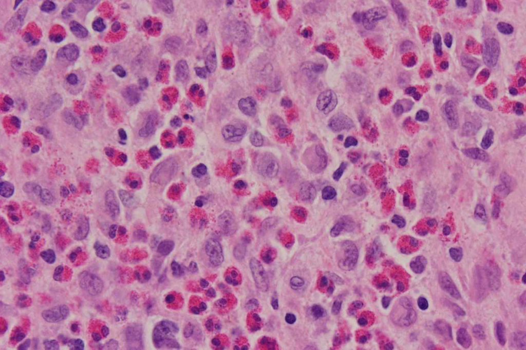 CD1a - Langerhans Cell Histiocytosis