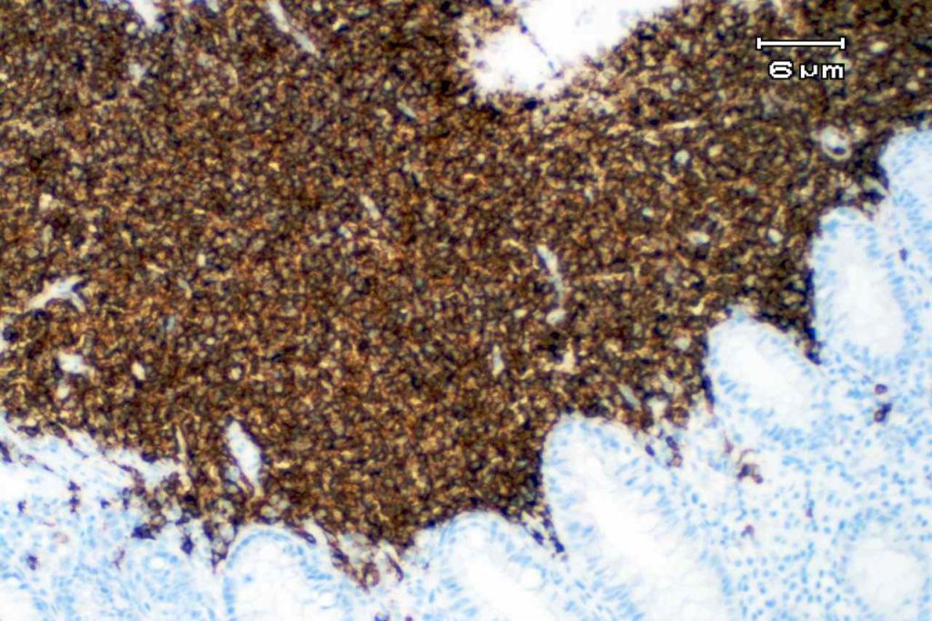 CD20 - Colon Mantle Cell Lymphoma