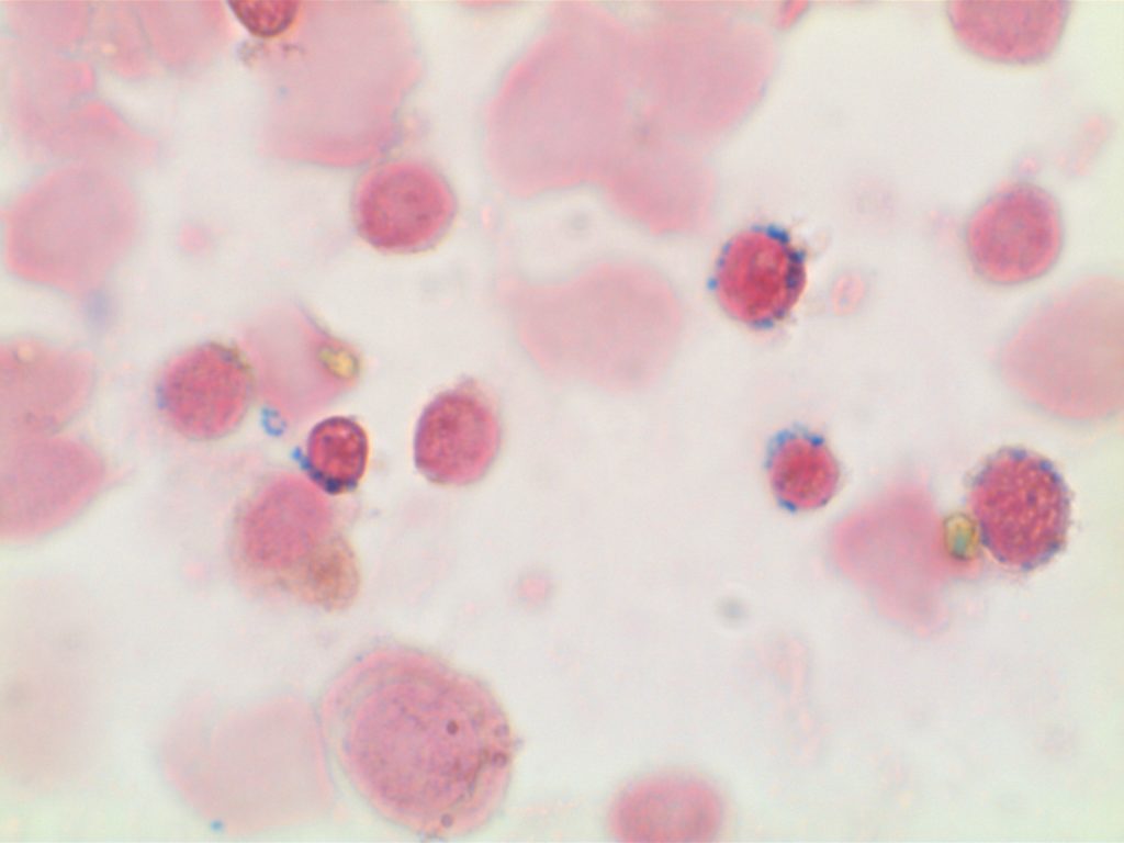 Ringed Sideroblasts in MDS