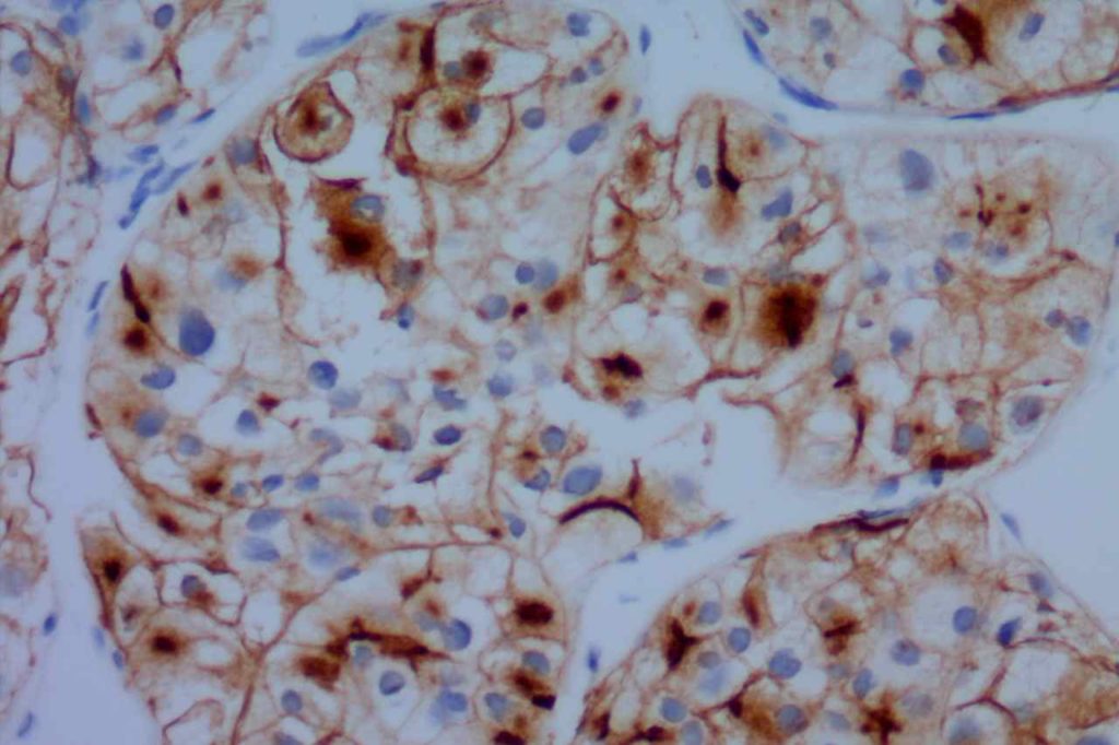 CD10 - Metastatic Renal Cell Carcinoma