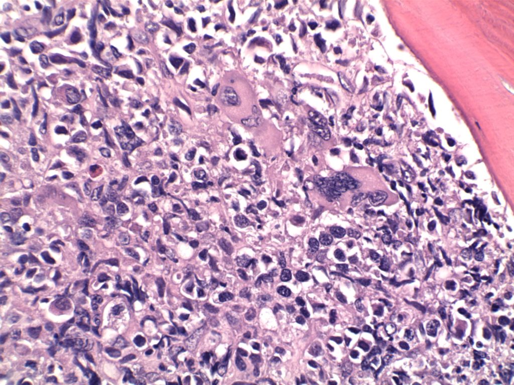 Primary Myelofibrosis (PMF)