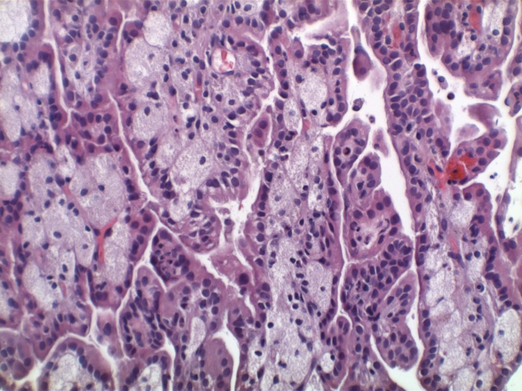 Papillary Renal Cell Carcinoma