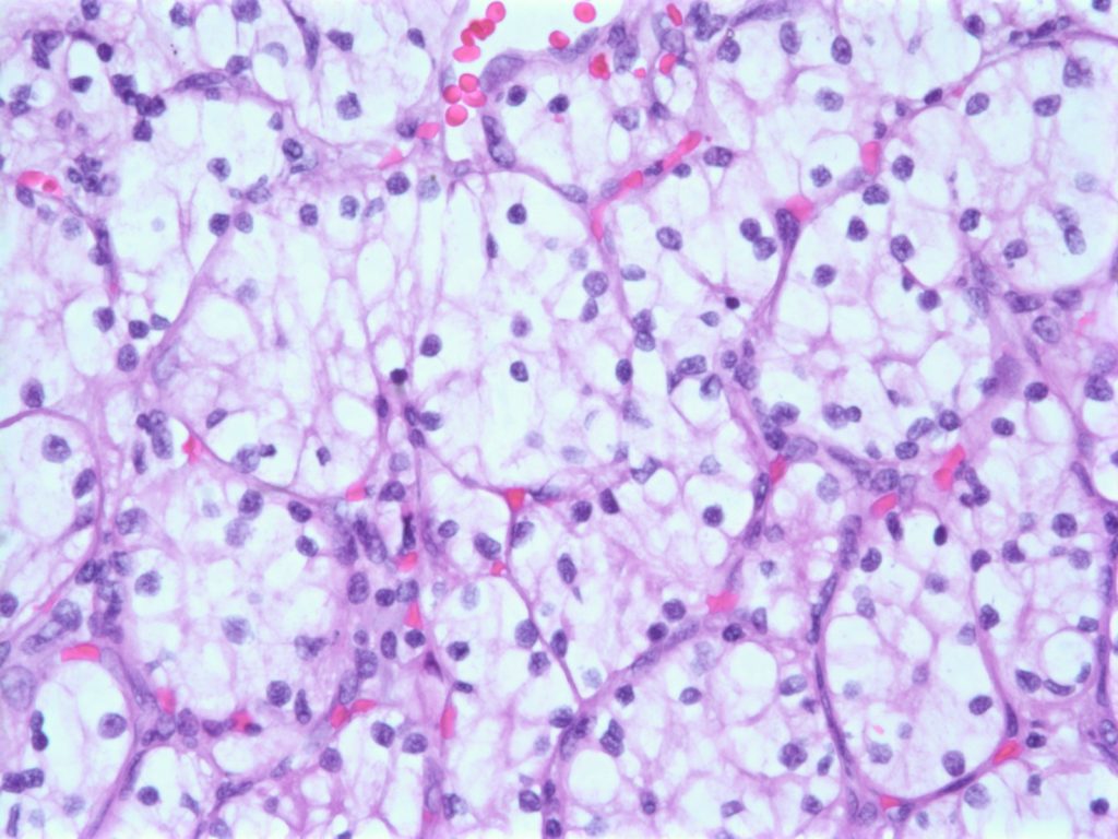 Clear Cell Renal Cell Carcinoma