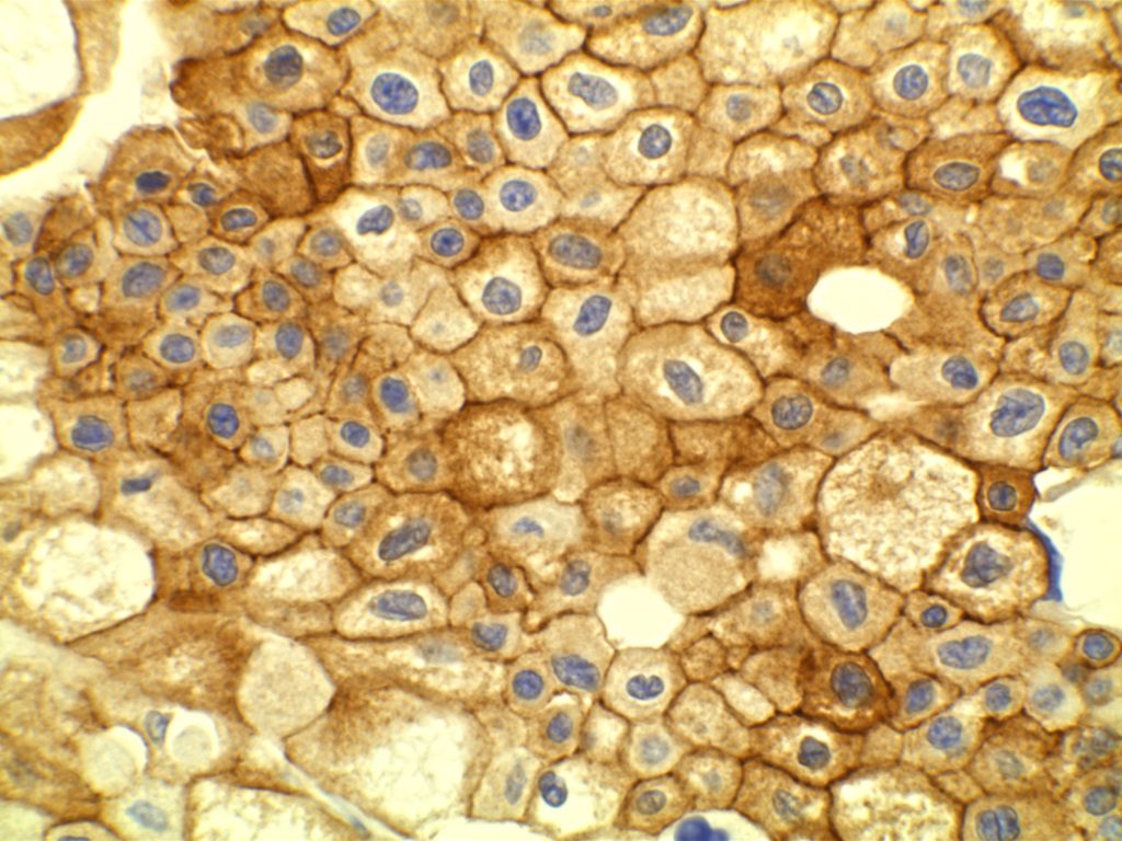 CD117 - Chromophobe Renal Cell Carcinoma