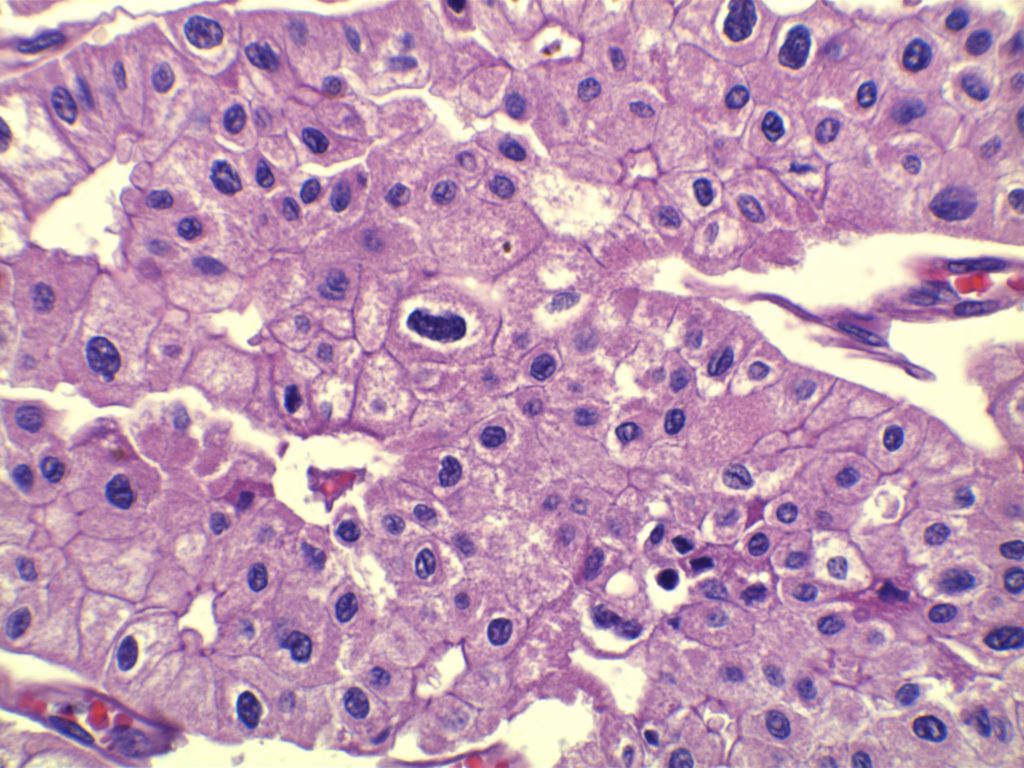 Chromophobe Renal Cell Carcinoma
