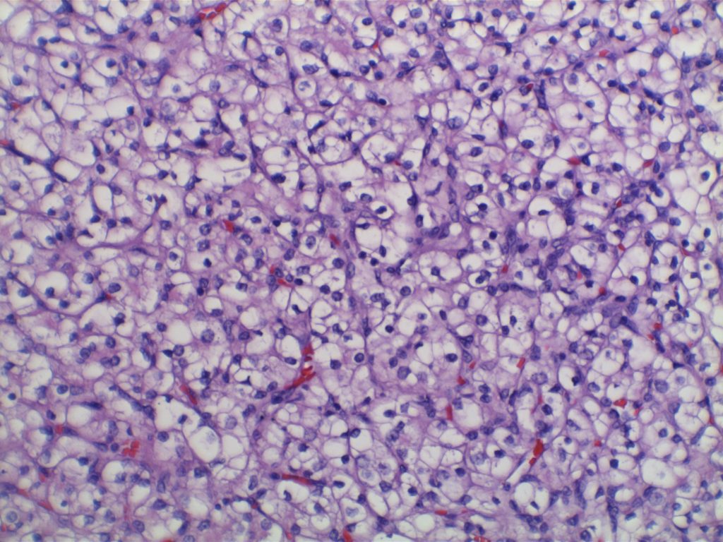 Clear Cell Renal Cell Carcinoma