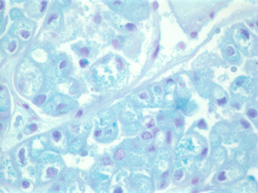 Chromophobe Renal Cell Carcinoma - Hales Colloidal Iron