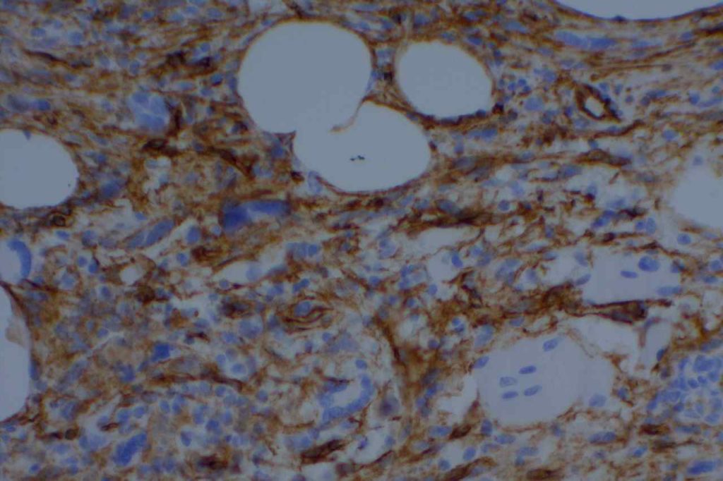 CD34 - Spindle Cell Lipoma