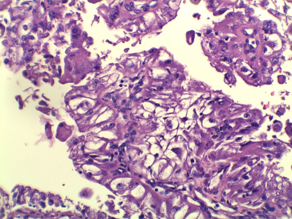 Xp11.2 Translocation Renal Cell Carcinoma