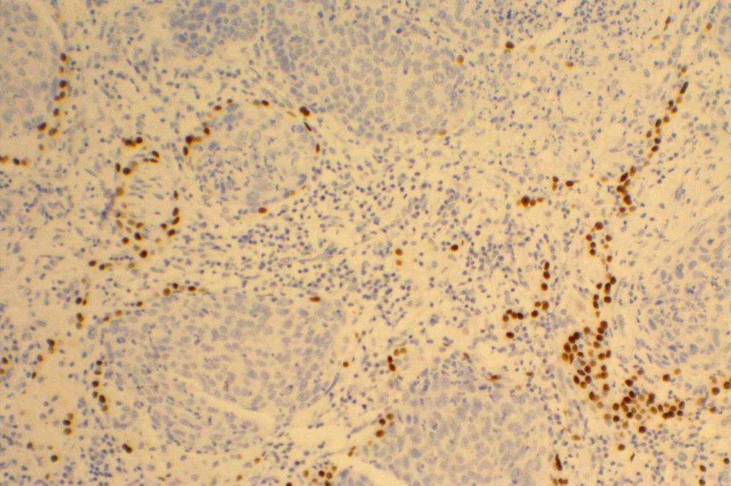 TTF-1 - Lung Squamous Cell Carcinoma
