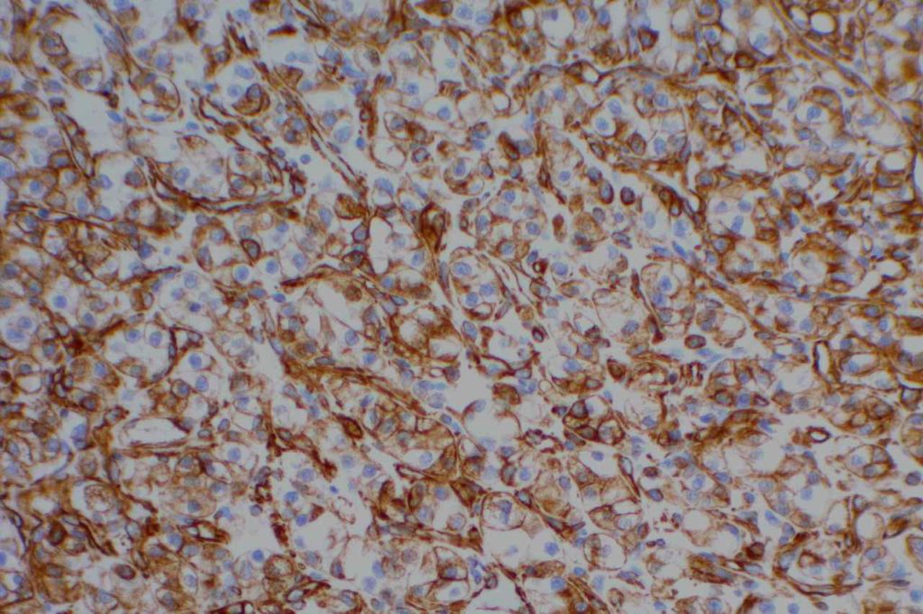 Vimentin - Renal Cell Carcinoma