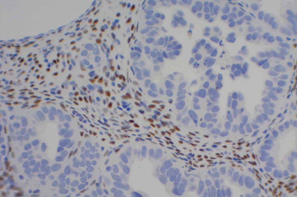 WT-1 - Stromal Cells