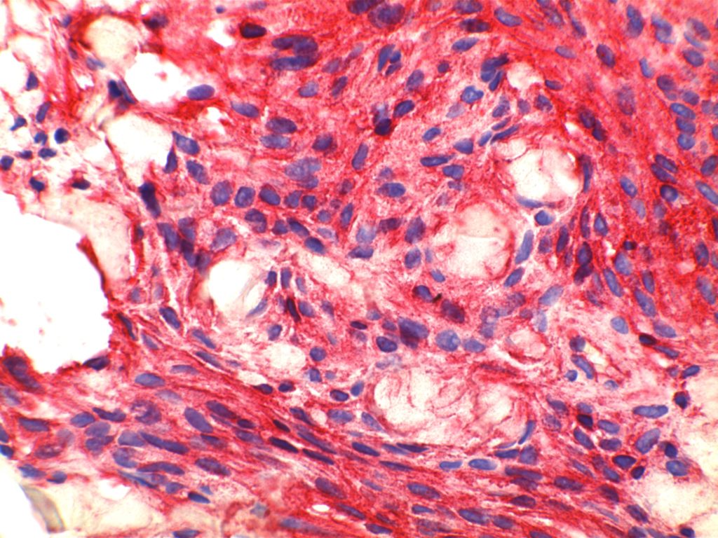 Myofibroblastoma - CD34