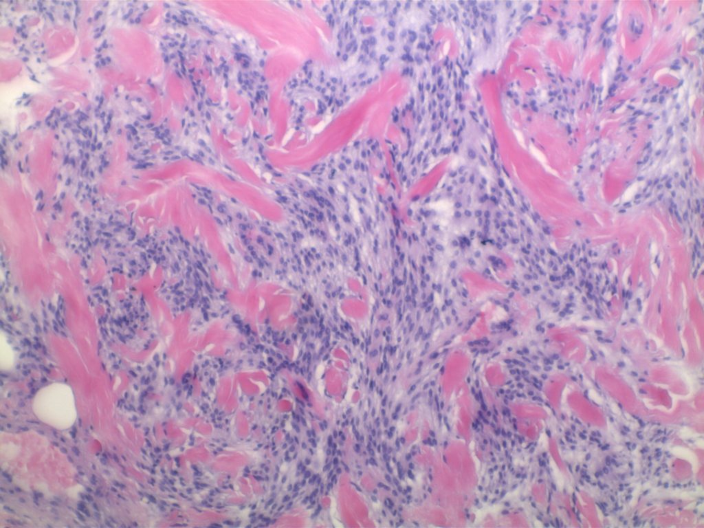 Myofibroblastoma of breast