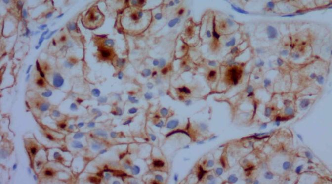 CD10 - Metastatic Renal Cell Carcinoma