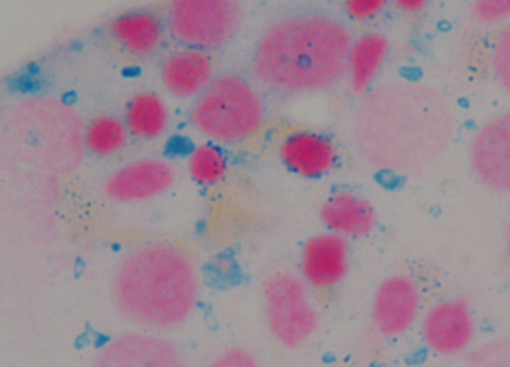 Ring Sideroblasts (Iron Stain)