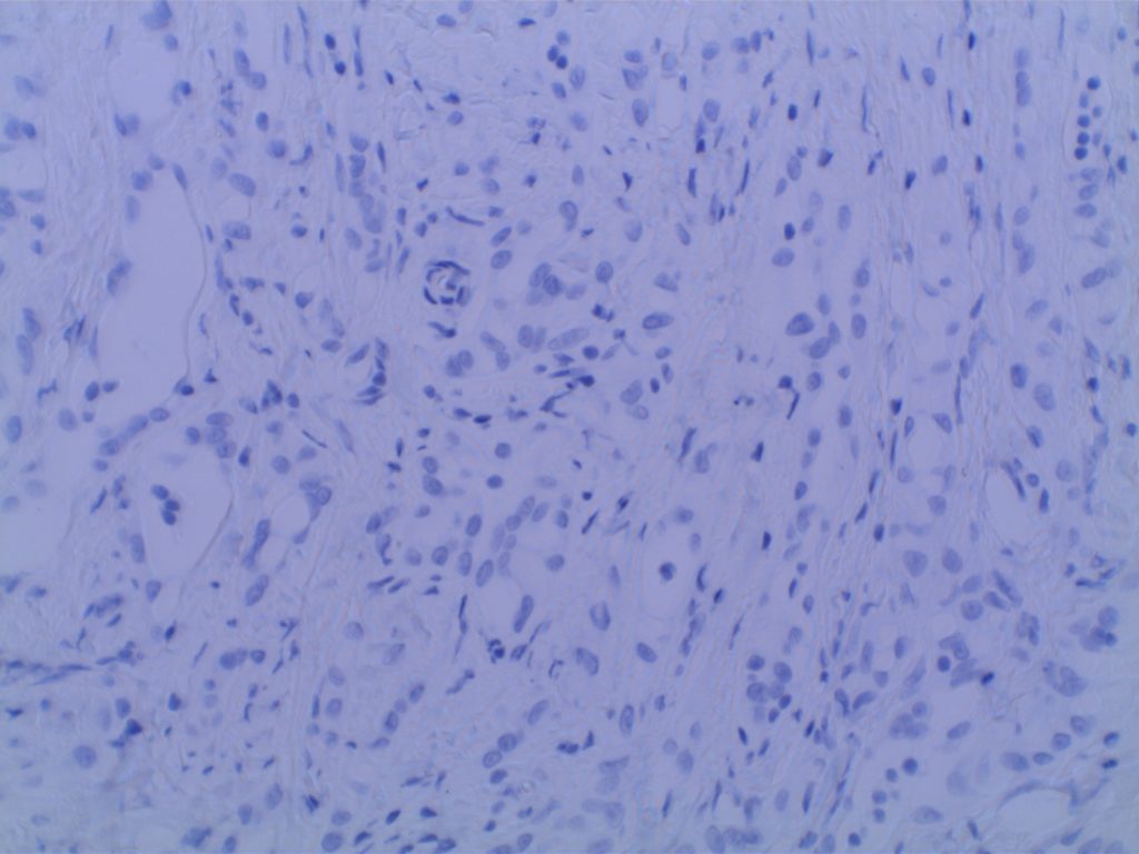 Adenomatoid Tumor CK20